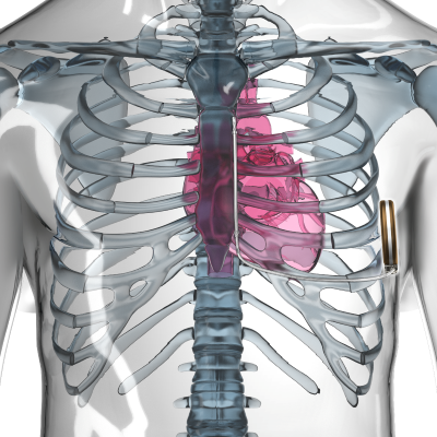An illustration of a chest shows an implantable cardioverter defibrillator (S-ICD) by the lower left ribs.