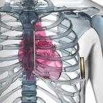 HeartLogic heart failure diagnostic is contained in certain Boston Scientific devices