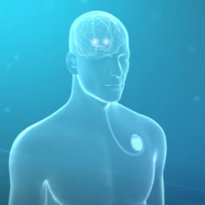 An anatomical rendering of a person with a deep brain stimulator implanted in their chest and two leads in their brain, a treatment which can help relieve Parkinson's symptoms.