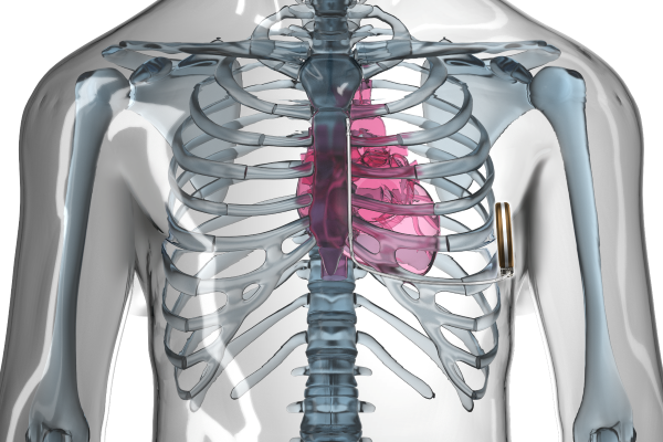An illustration of a chest shows an implantable cardioverter defibrillator (S-ICD) by the lower left ribs.