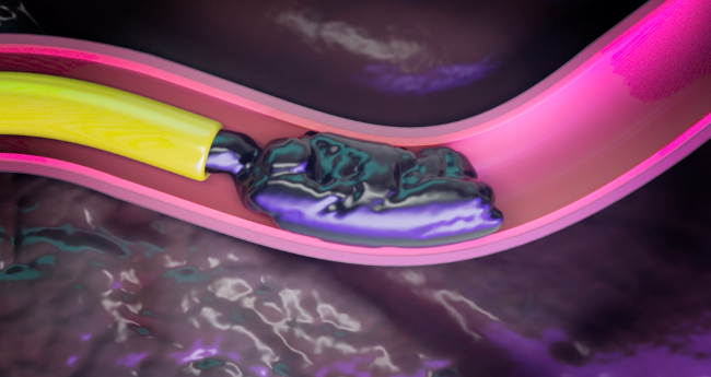 An animation of a pink blood vessel, inside of which a yellow catheter is releasing the black, gooey Obsidio embolic agent.