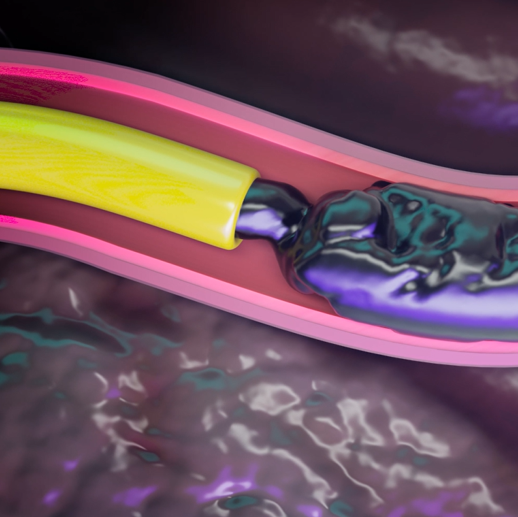 An animation of a pink blood vessel, inside of which a yellow catheter is releasing the black, gooey Obsidio embolic agent.
