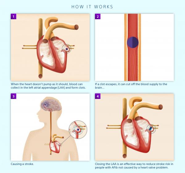 Four illustrated panels show how AFib can cause stroke, and how sealing off the heart's LAA with WATCHMAN can help reduce the risk.