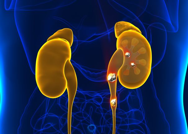 illustration of kidney stones in body